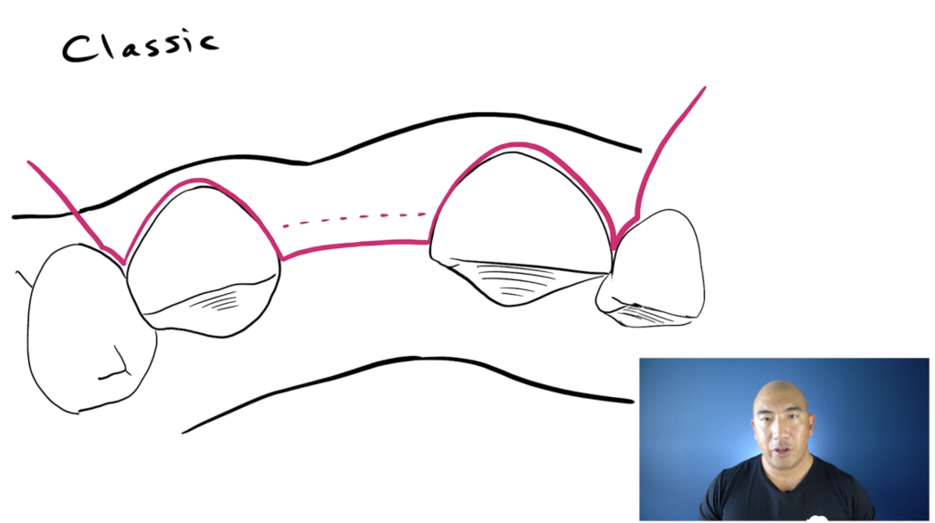 Papilla Sparing Flap Design – Video Library – Implant Ninja Dojo